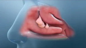 Burun Estetiği Kimlere Yapılır