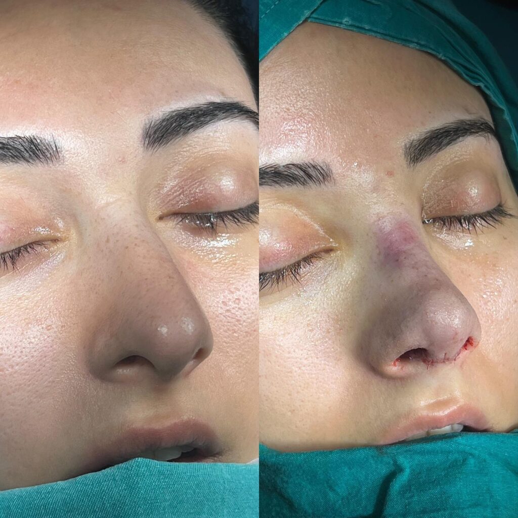 Burun Estetiği Öncesi ve Sonrası Dikkat Edilmesi Gerekenler 2 Burun Estetiği Sonrası Dikkat Edilmesi Gerekenler