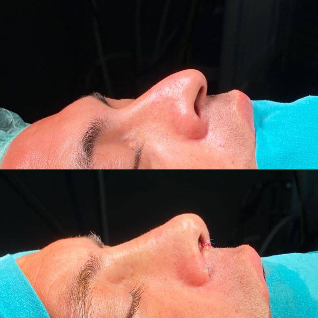 Burun Estetiği Ameliyatında Kullanılan Teknikler