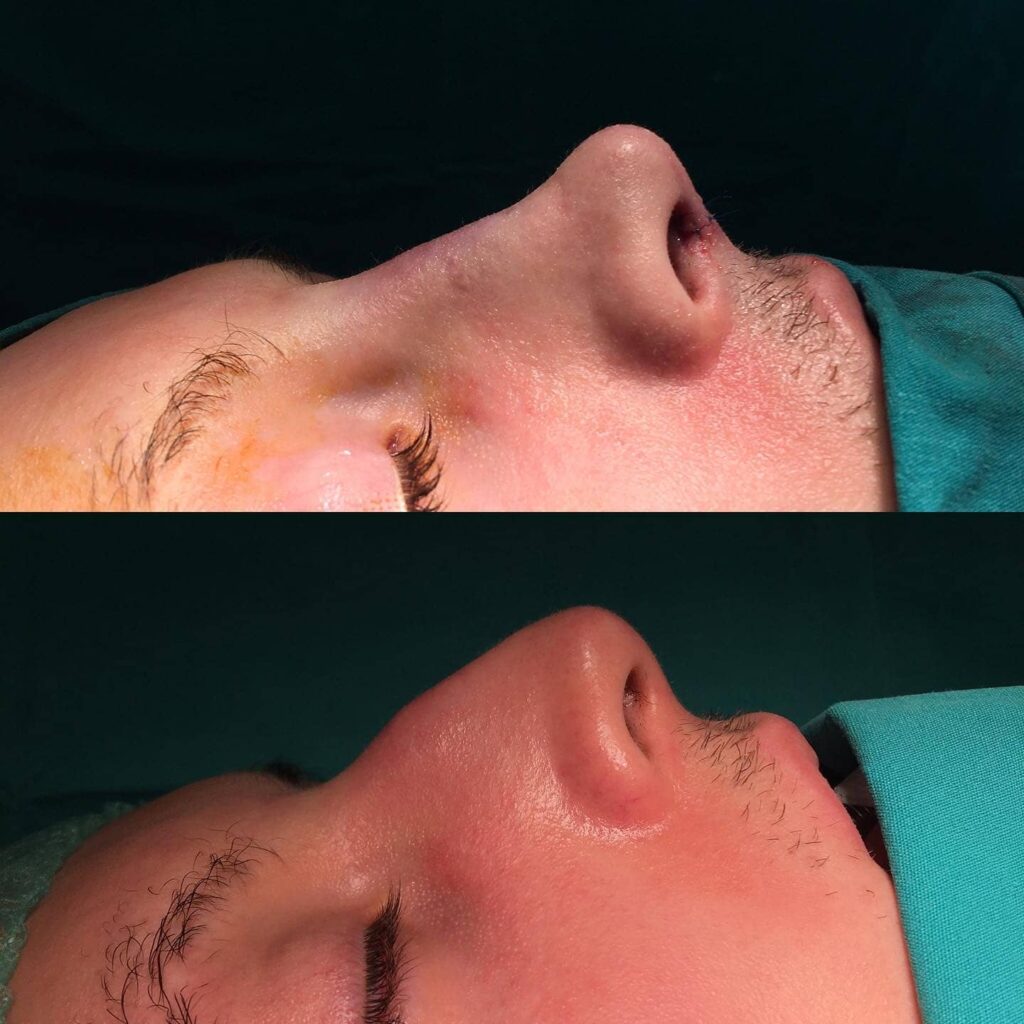 Burun Estetiği Fiyatları