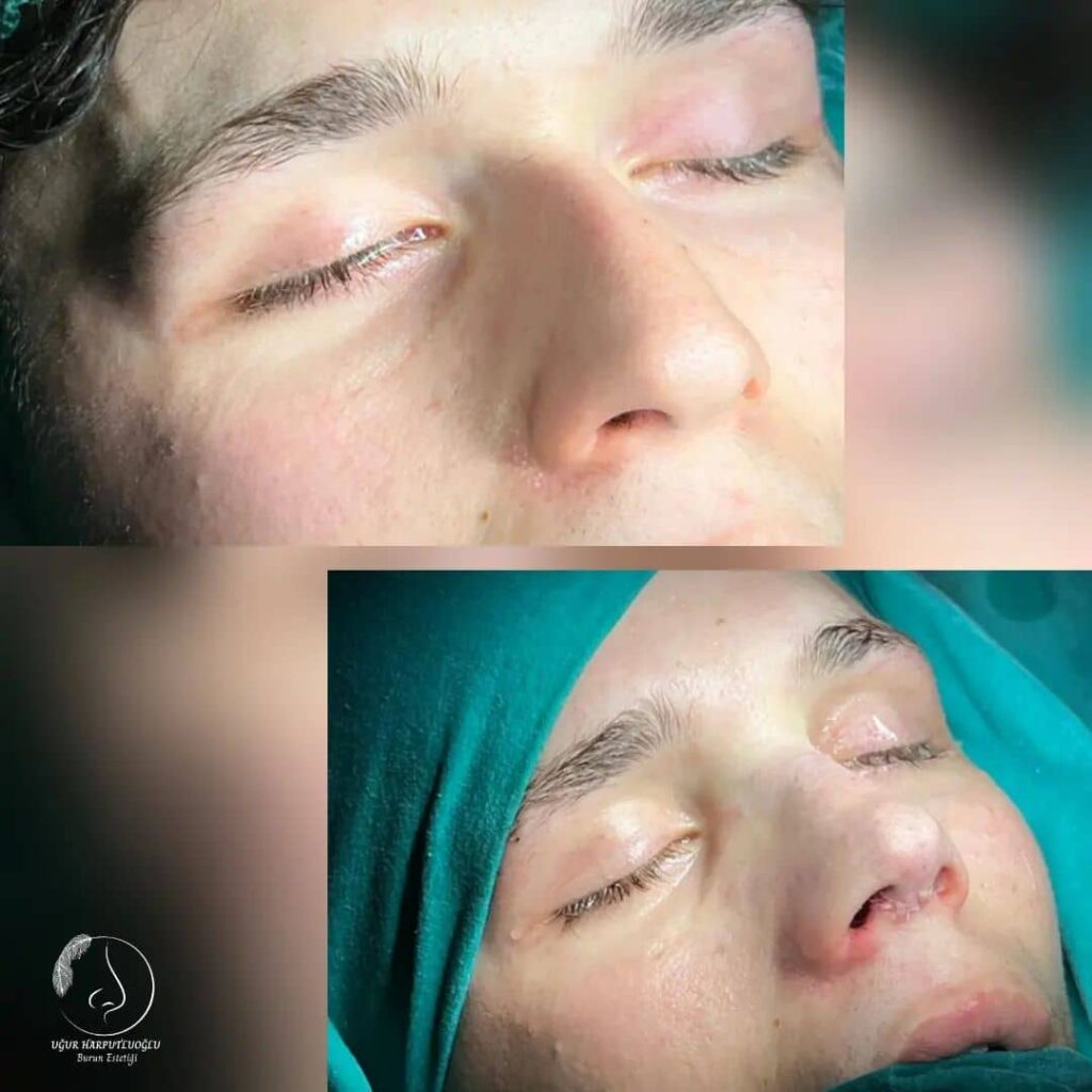Burun Estetiği Sonrası Bakım İpuçları