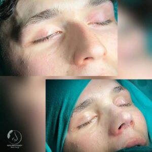 Burun Estetiği Sonrası Bakım İpuçları