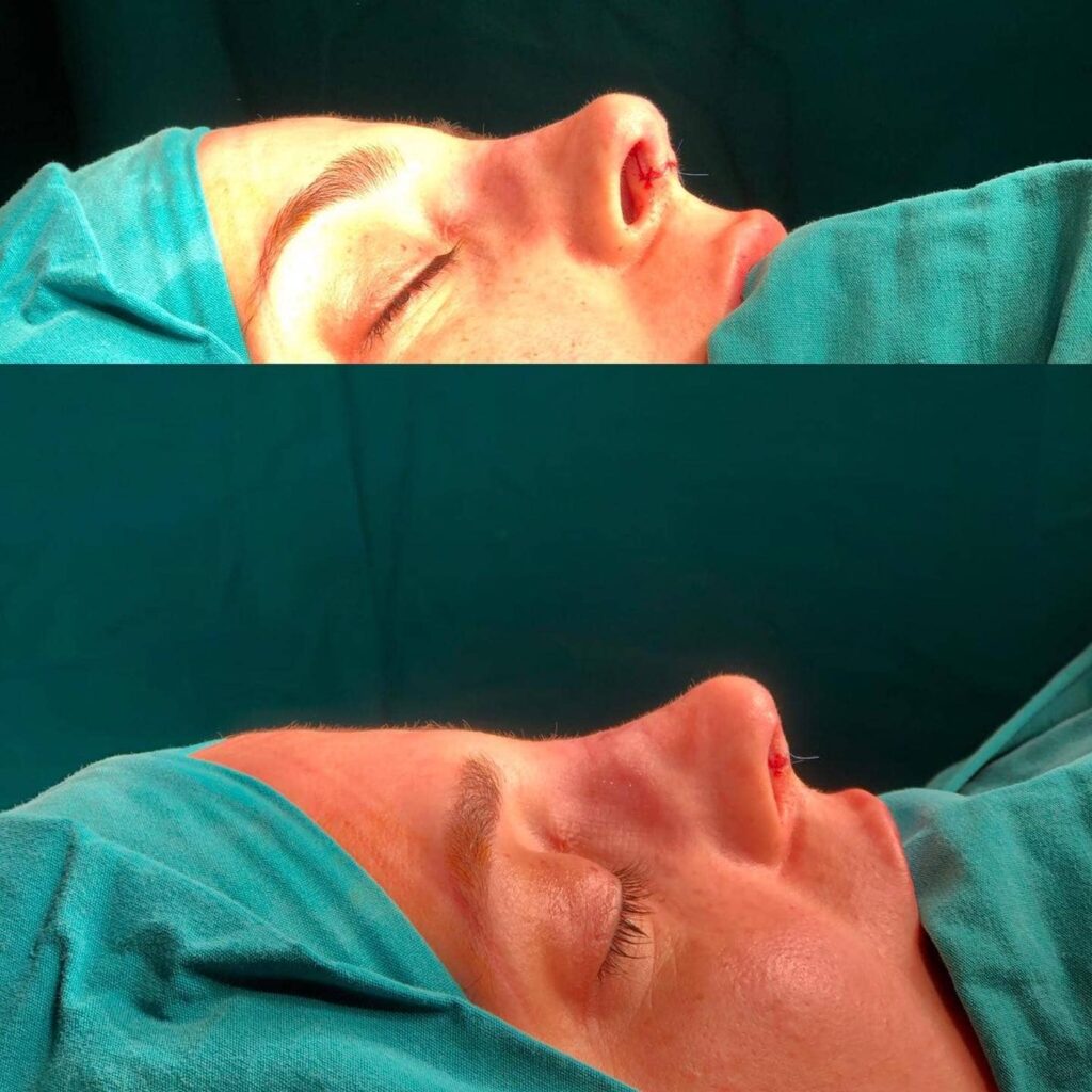 Burun Estetiği ile İlgili Sık Sorulan Sorular