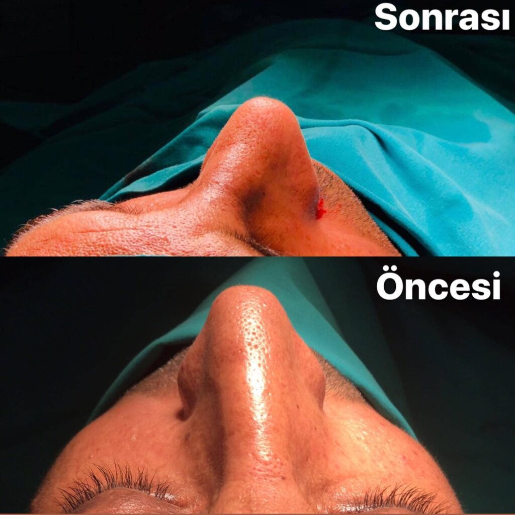 Rinoplasti Fiyatları Neye Göre Değişir