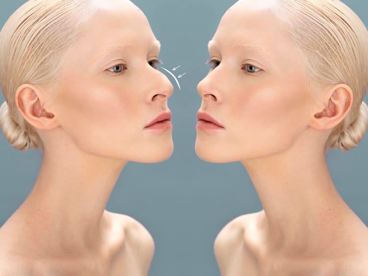 Burun Kemiği Eğriliği (Deviasyon) ve Tedavi Seçenekleri