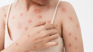 Maymun Çiçeği Virüsü (Mpox) Türkiyede Gündemde Yeni Varyant Tehlikesi mi