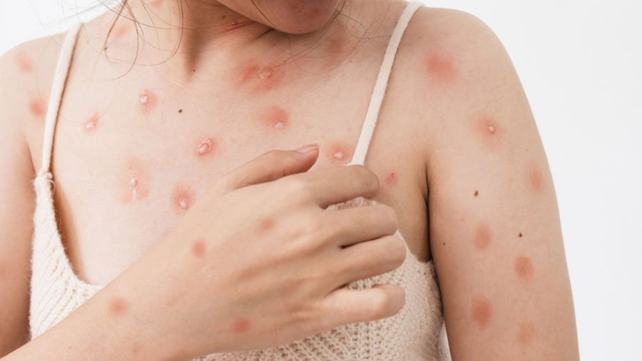 Maymun Çiçeği Virüsü (Mpox) Türkiyede Gündemde Yeni Varyant Tehlikesi mi
