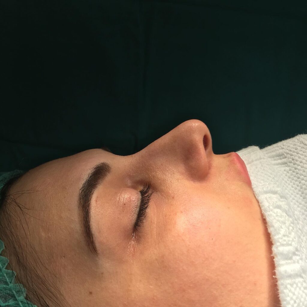 Uğur Harputluoğlu Rinoplasti Ameliyatı