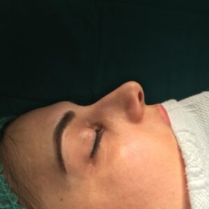Uğur Harputluoğlu Rinoplasti Ameliyatı