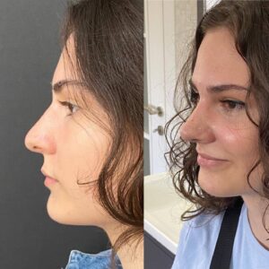 Rinoplastinin Psikolojik Etkileri Daha İyi Bir Benlik Algısı