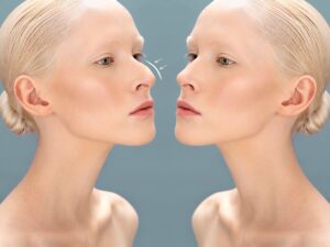 Septoplasti Sonrası Nefes Alma Problemlerinin Çözümü