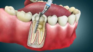 Anasayfa 16 Kanal Tedavisinde Dentvital’i Tercih Etmeniz İçin 10 Güçlü Neden