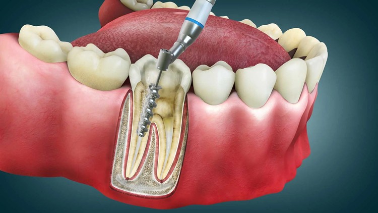 Kanal Tedavisinde Dentvital’i Tercih Etmeniz İçin 10 Güçlü Neden